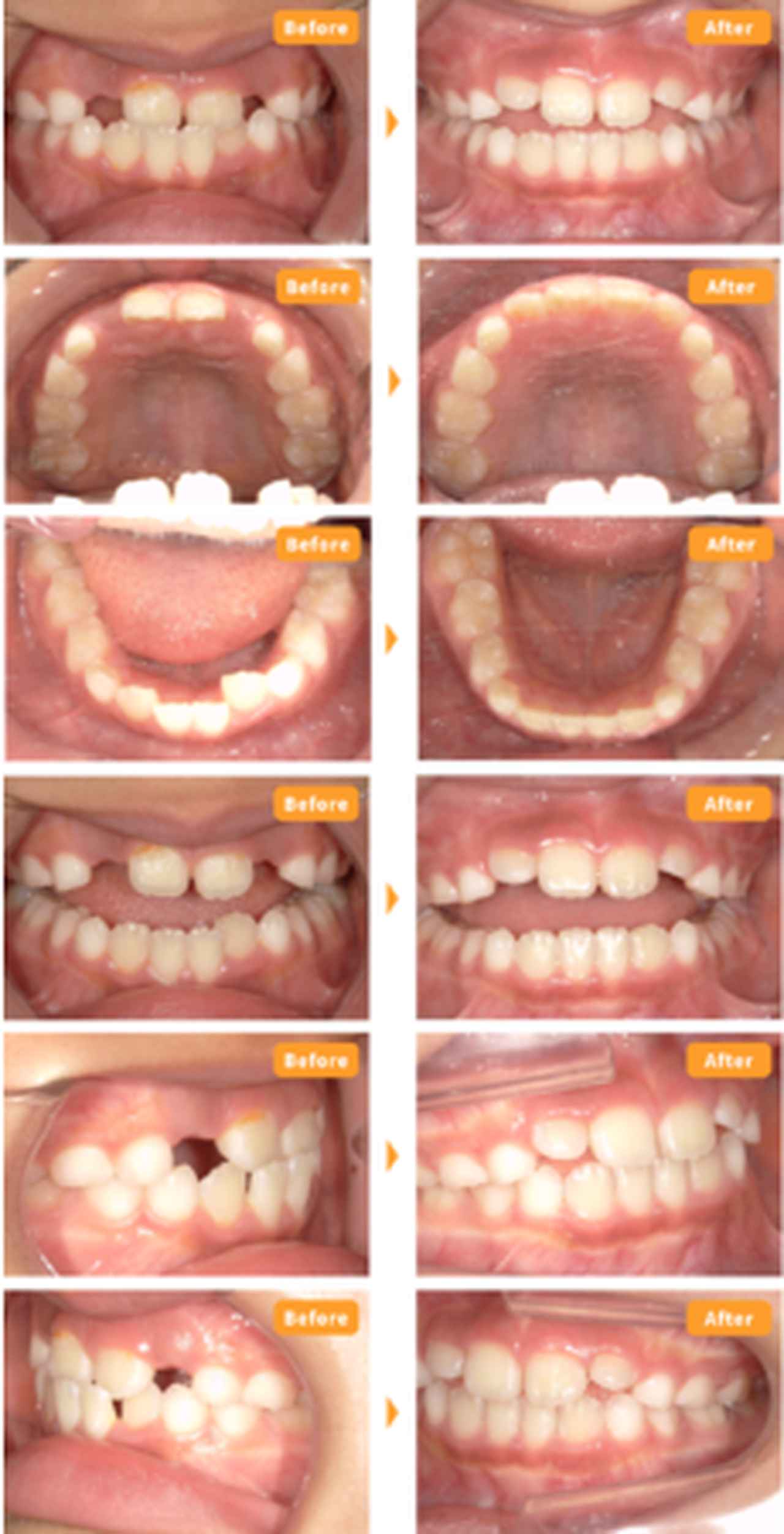 画像2: 3~5歳の反対咬合のお子様も治療可能に！