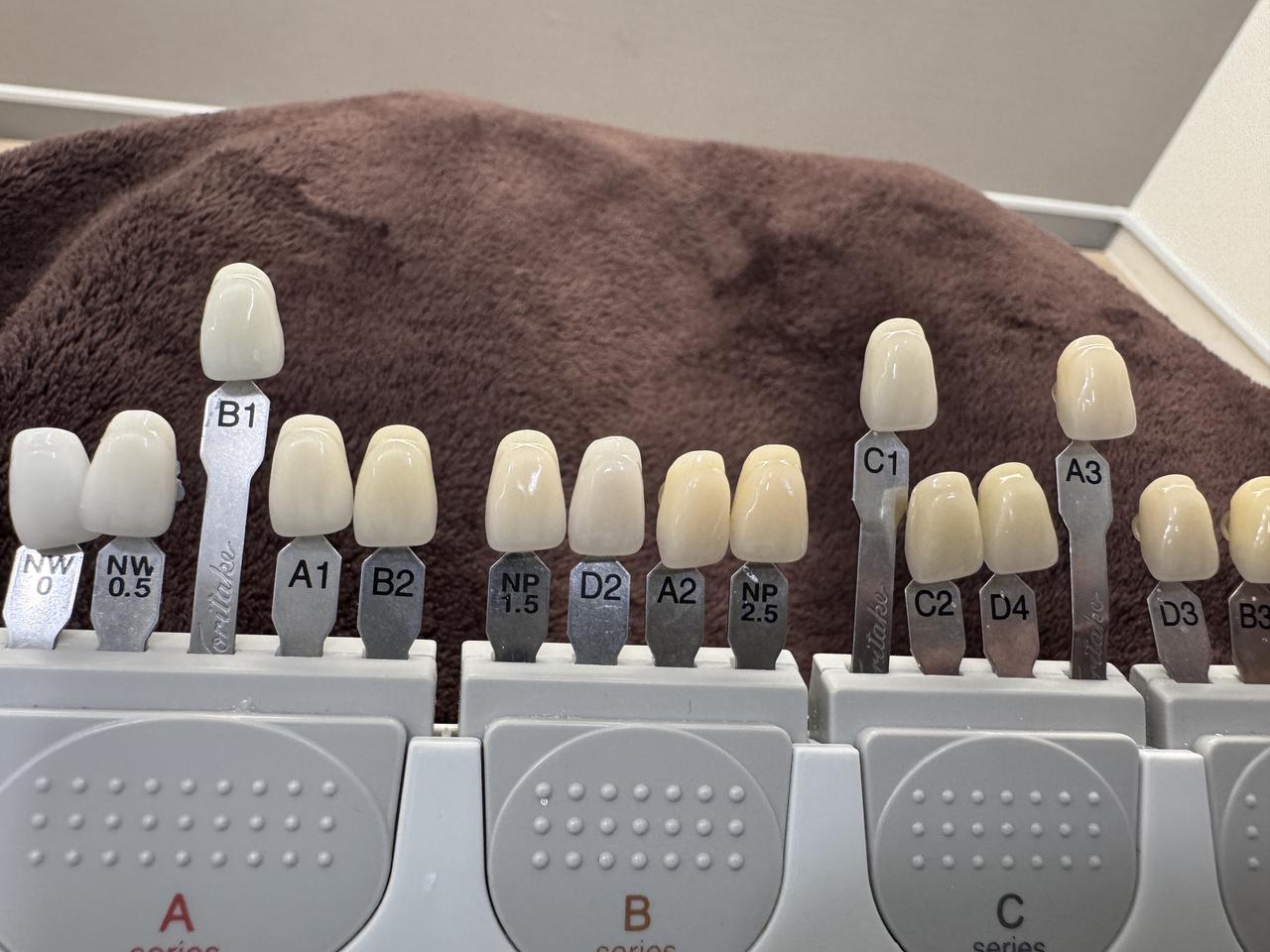 画像: 施術前（B1は目標）前歯がC1、犬歯がA3