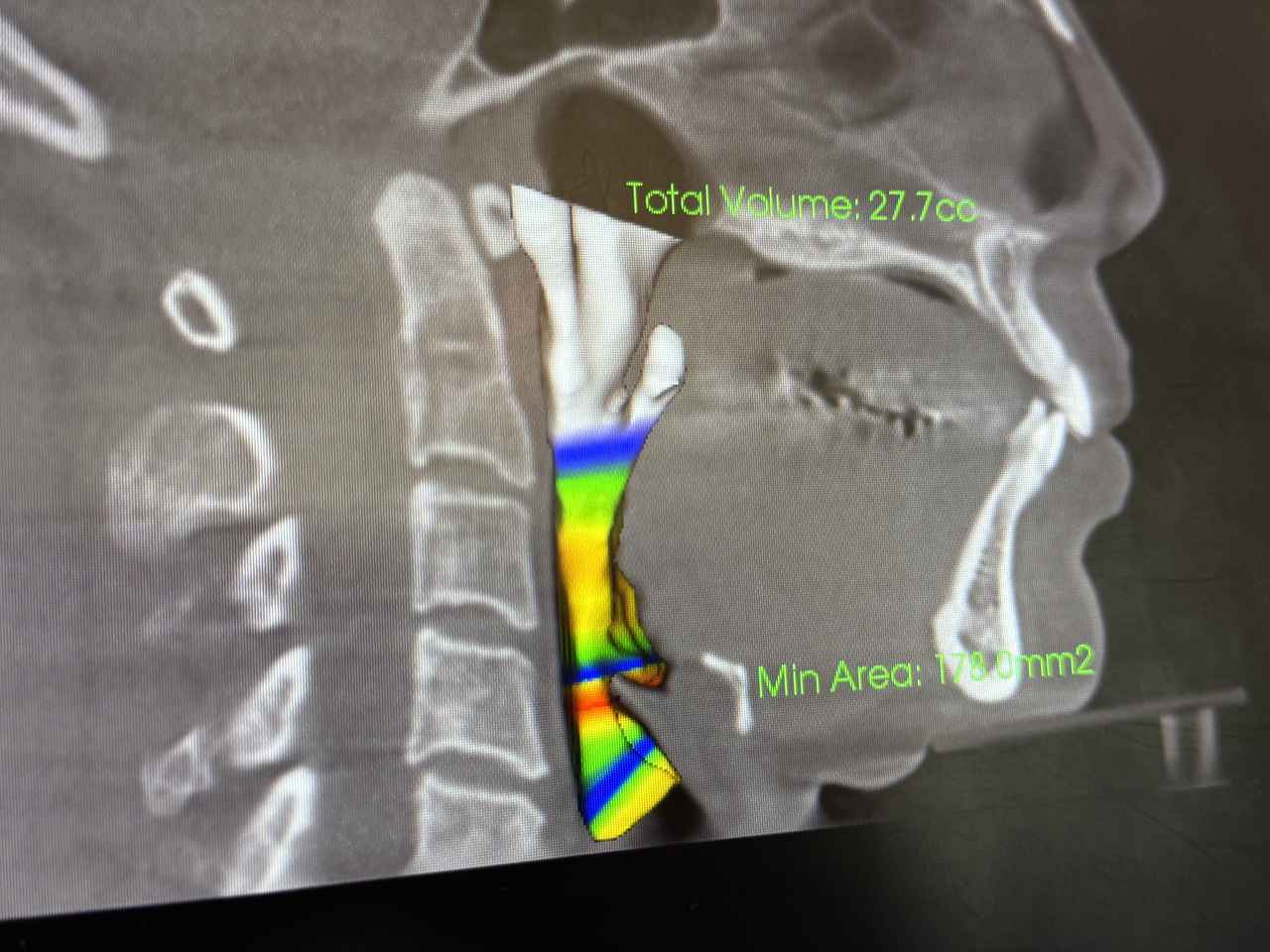 画像: 気道が狭くなっているのまでわかります。