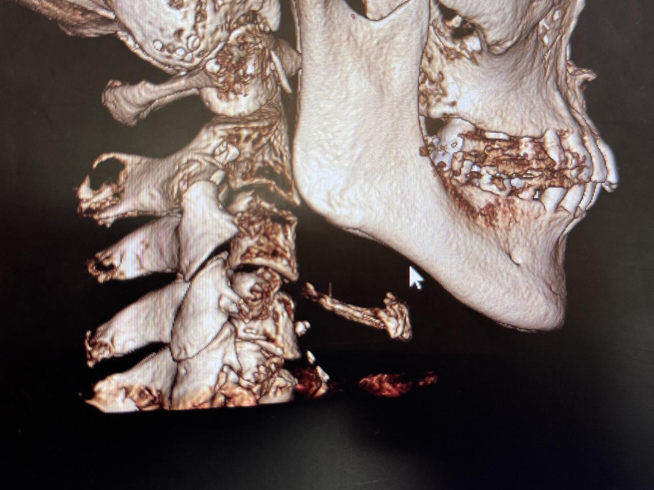 画像: 強い奥歯の噛みしめで頭蓋骨にまで影響がでていることが判明