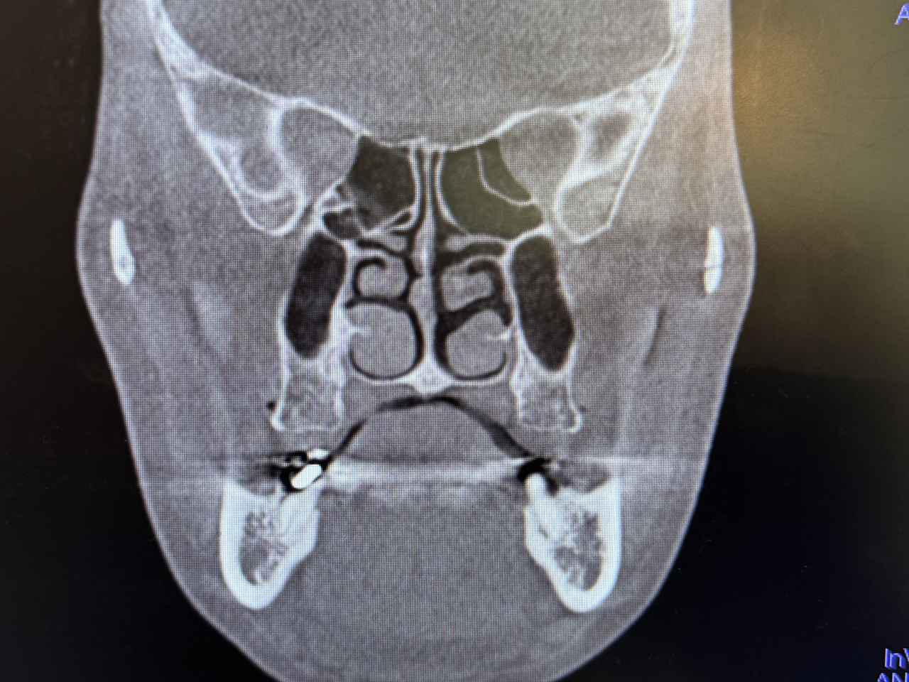 画像: 鼻の周りが詰まっているとのこと。鼻づまりなんて体験なかったのでショックでした。