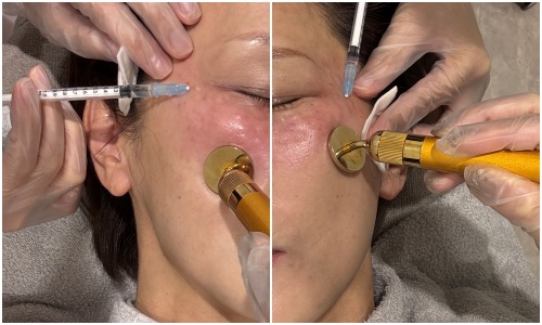 画像: リジュランアイは、肌再生を促すポリヌクレオチド(PN)を注入することで、目元のハリ・弾力・透明感を引き出す施術。 (リジュランアイ 価格:73,000円)