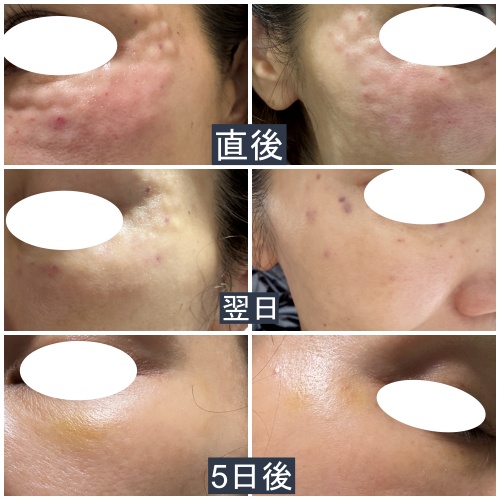 画像5: “目元と肌印象”を整えるナチュラル美容医療体験♡【東京美容クリニック】で「リジュランアイ」と「スキンボトックス」を体験