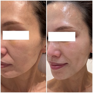 画像: 直後でこの効果。くすみがとれ、透明感が出現し艶まで。 脂肪を減らさず理想の輪郭へ。