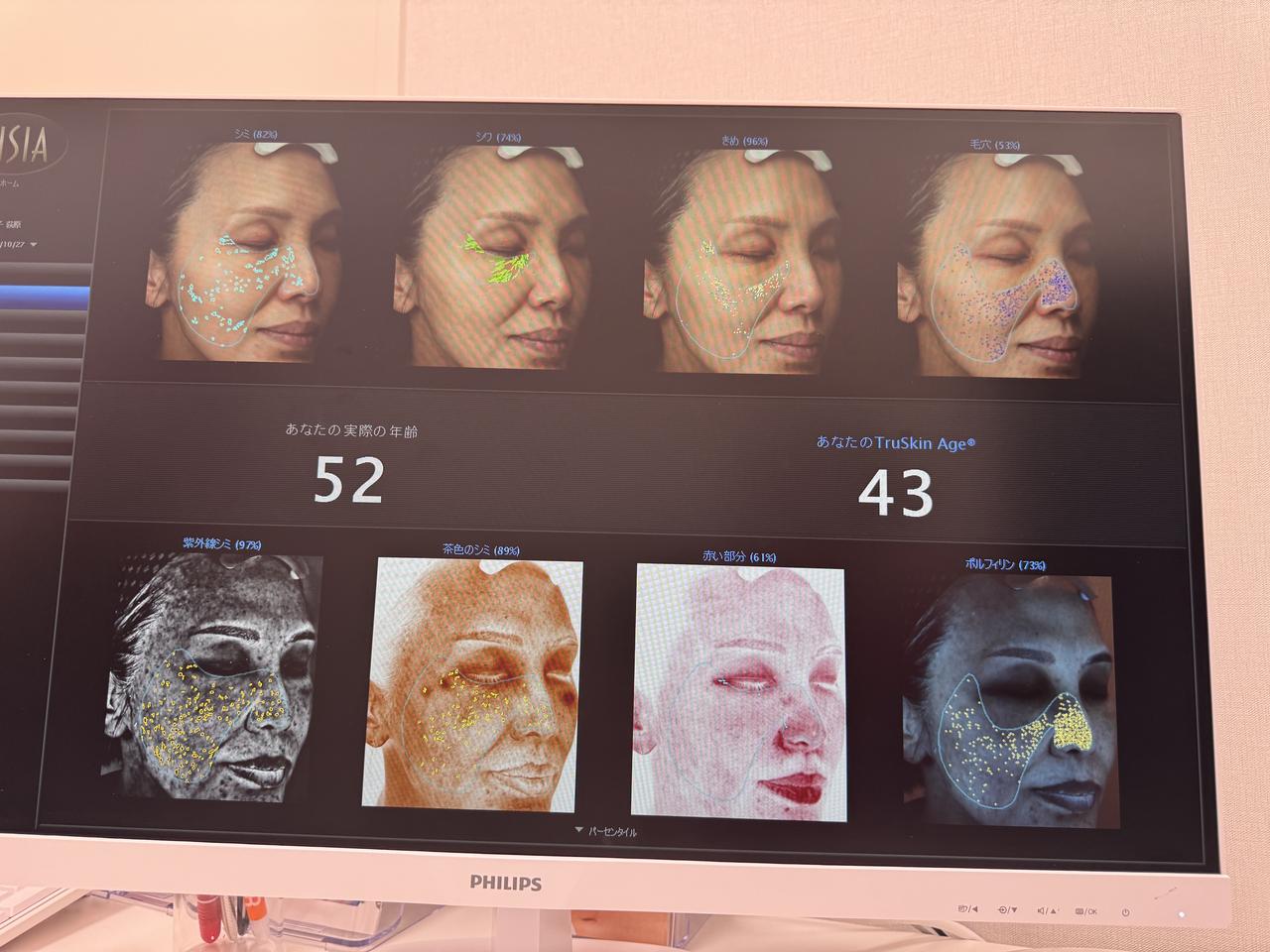 画像: VISIA検査値最大9歳までとのこと。30代目指してます！小鼻脇の毛細血管の赤み、鼻回りの毛穴など、普段気になっているところが如実に！