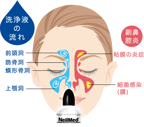 画像2: cp-sinusrinse.neilmed.jp
