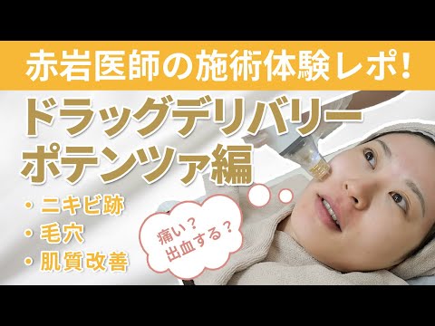 画像: 【人気のポテンツァ】痛い?出血は?ニキビ跡や毛穴への効果は?医師が体当たりレポ! #ポテンツァ #美容医療 #リゼクリニック youtu.be