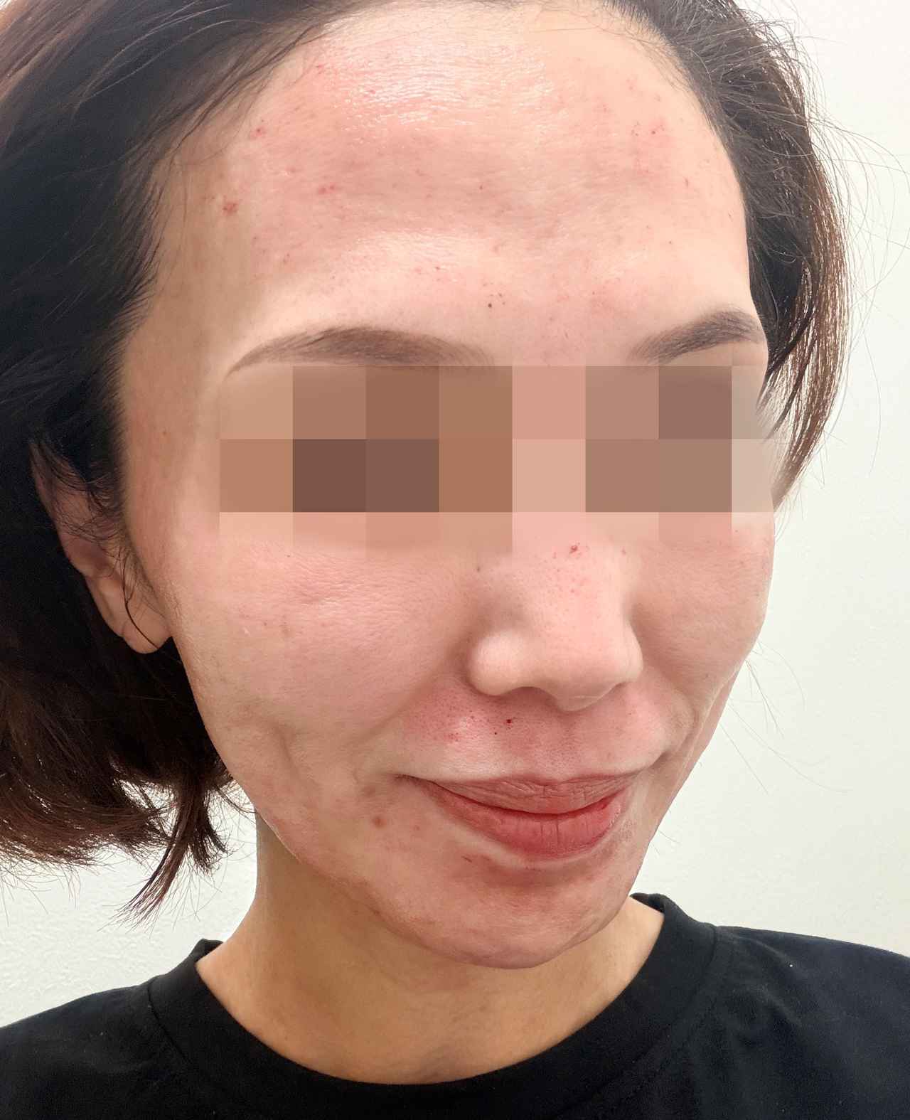 画像: 施術直後