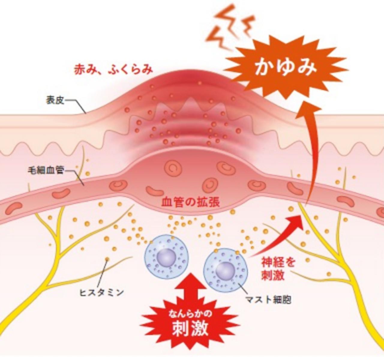 画像: “原因不明のかゆみ”に悩んでない？働く女性を脅かす「慢性特発性蕁麻疹（CSU）」の新常識