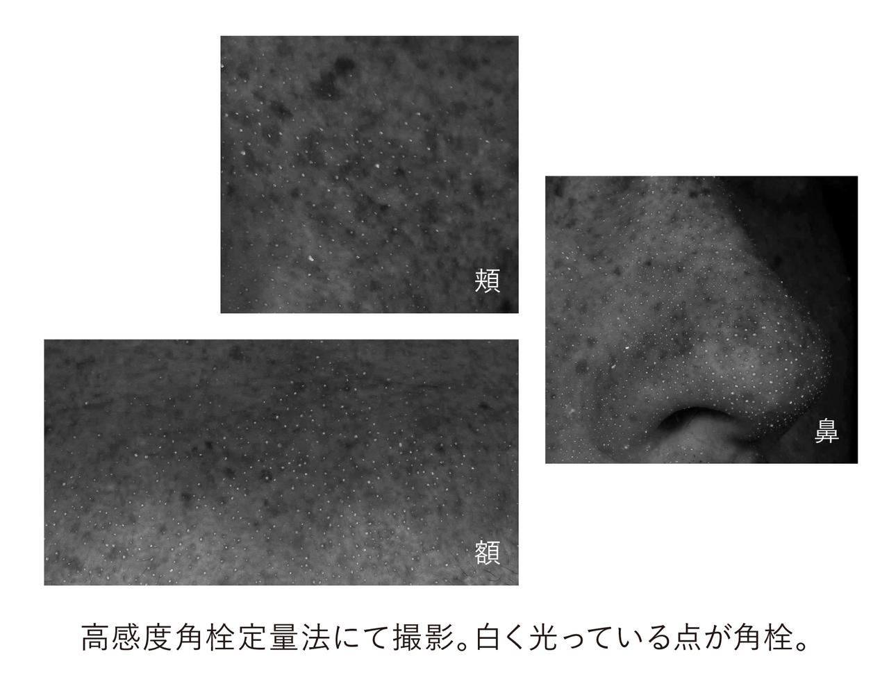 画像: 角栓の実態
