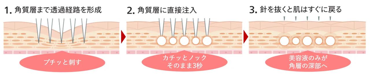 画像: 3. 医療技術から着想を得た「ノック注入型(※1)マイクロニードル」