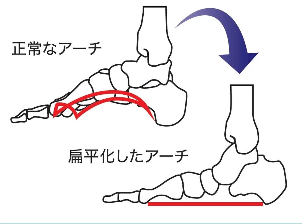 画像: なぜ足裏が疲れるの?原因は「アーチの崩れ」にあり!