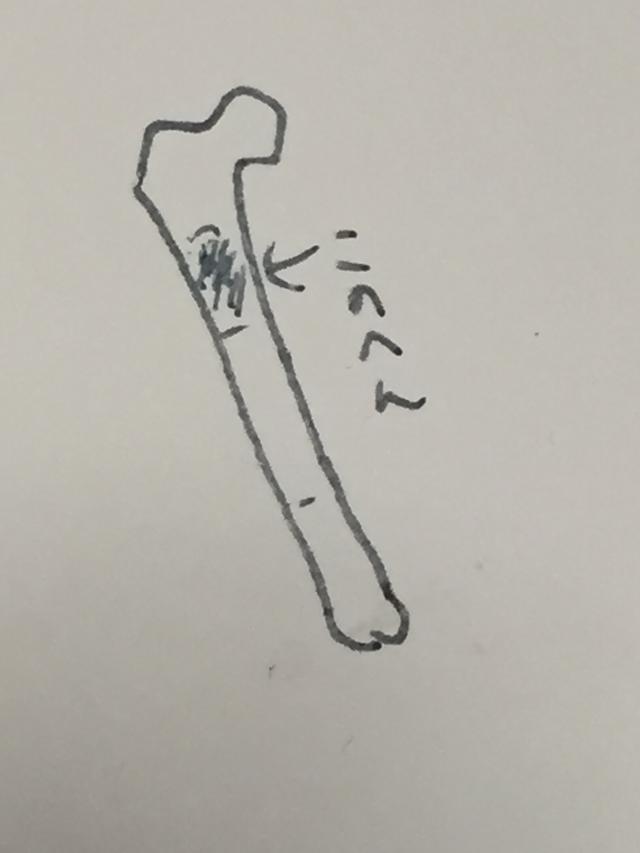 画像: 大腿骨イラスト