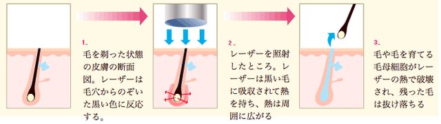 画像: レーザー脱毛のメカニズム www.epi.ac