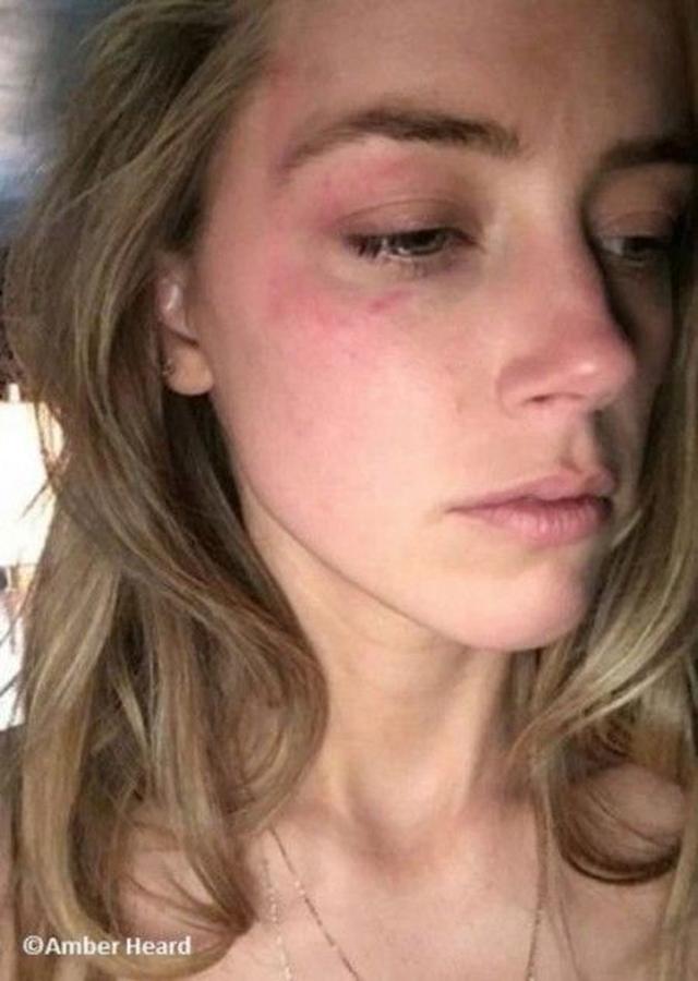 画像2: アンバー・ハードがジョニー・デップのDVを告発! 離婚問題が泥沼化