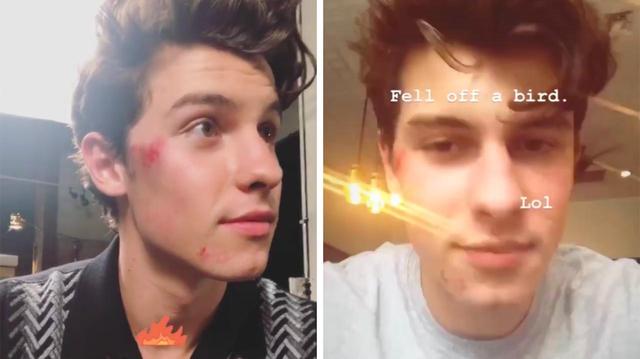 画像: インスタグラムに投稿した動画で顔の傷を公開。 ©Shawn Mendes/Instagram
