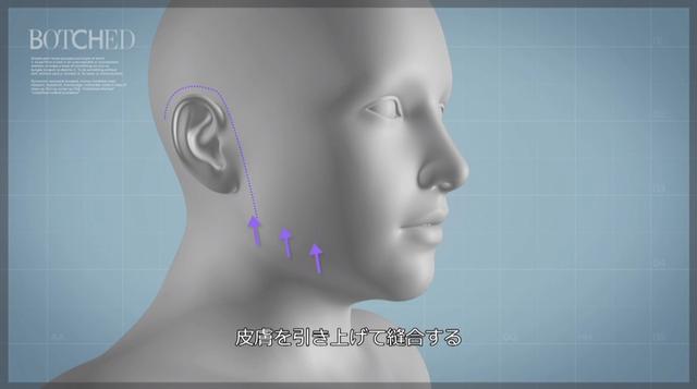 画像5: カリスマ医師が 四角型からハート型 へと輪郭を形成