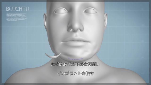 画像2: カリスマ医師が 四角型からハート型 へと輪郭を形成
