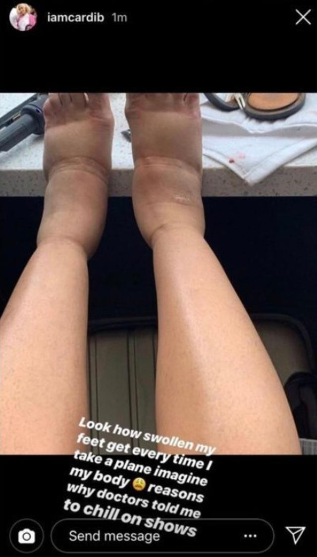 画像: カーディーがインスタグラムで公開した腫れ上がった両足の写真。©Cardi B/ Instagram