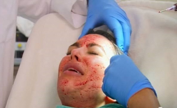 画像: 『カーダシアン家のお騒がせセレブライフ』のスピンオフ番組『Kourtney & Kim Take Miami』内でPRP施術を受けたキム。