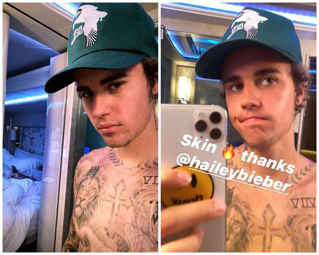 画像: ニキビとおさらばし「ありがとう、ヘイリー」と妻に感謝するジャスティン・ビーバー。 ©︎Justin Bieber/Instagram