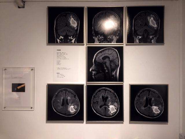画像: CTスキャン画像。白い部分が脳出血を発症した箇所だという。