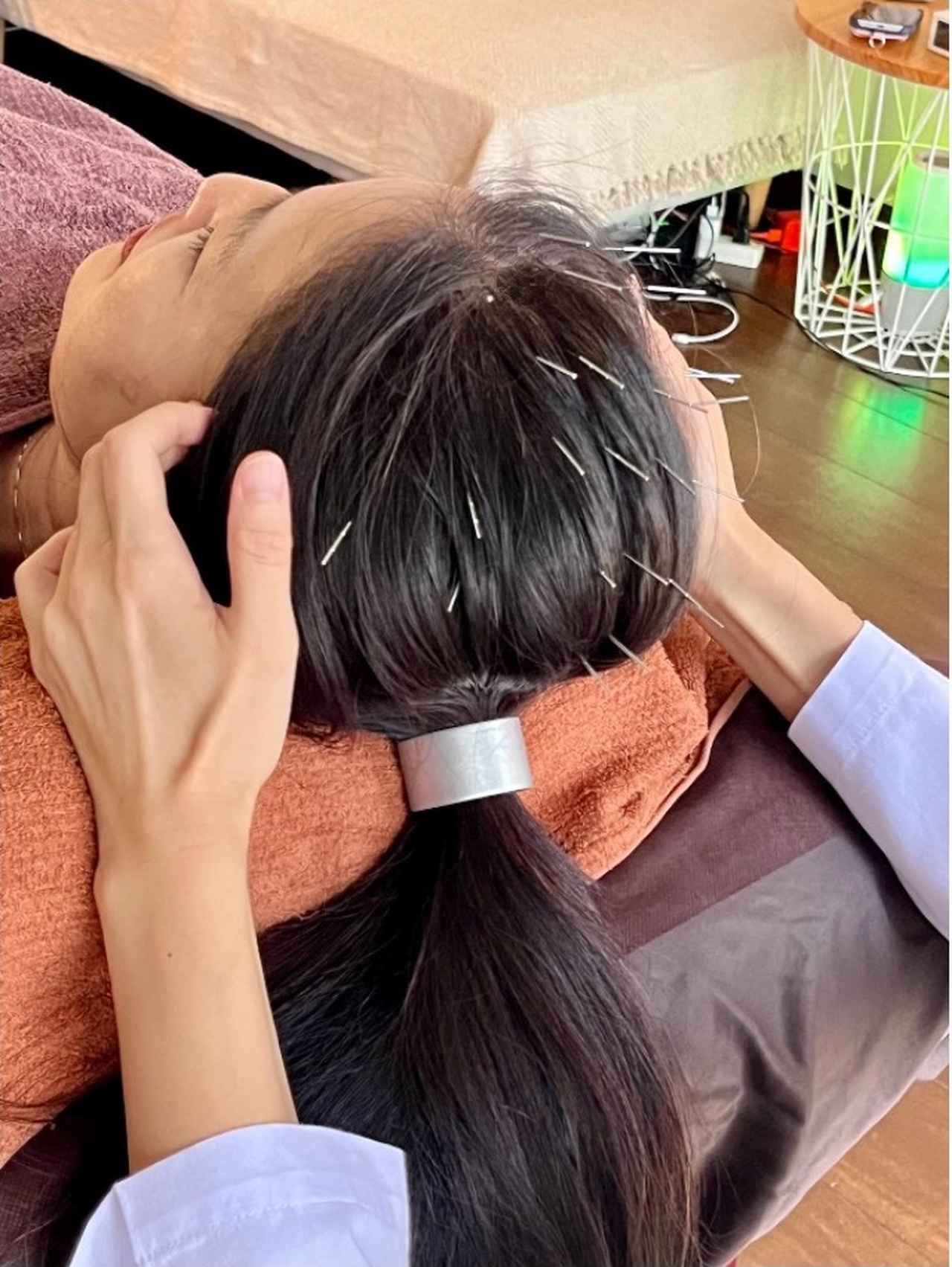 画像: 施術中、気づけば頭には鍼がびっしり!見た目には痛そうだが、刺さっている感覚はほぼないのが不思議