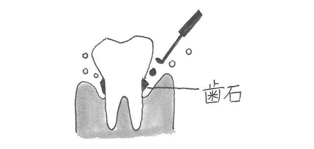 画像: 3カ月ごとに歯科医での歯石ケアを