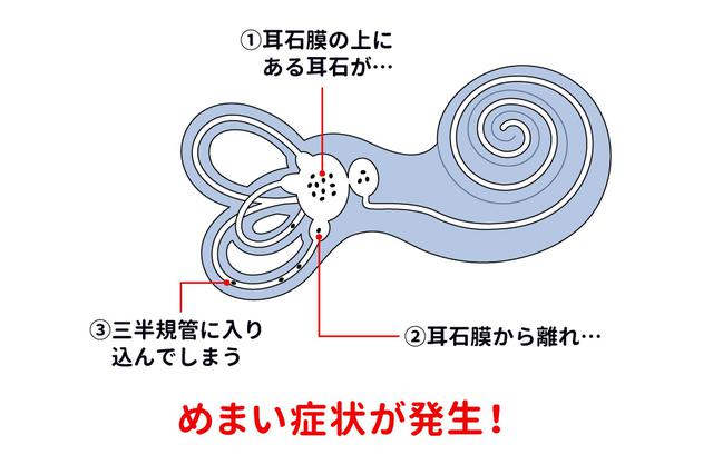 画像: めまいが起こるメカニズムとは?