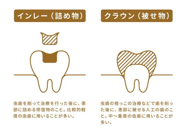 画像: (3)虫歯(欠損)の治療