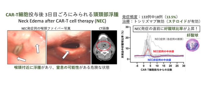 CAR-T療法、CRS発症直後の頭頸部浮腫の発症頻度やバイオマーカー