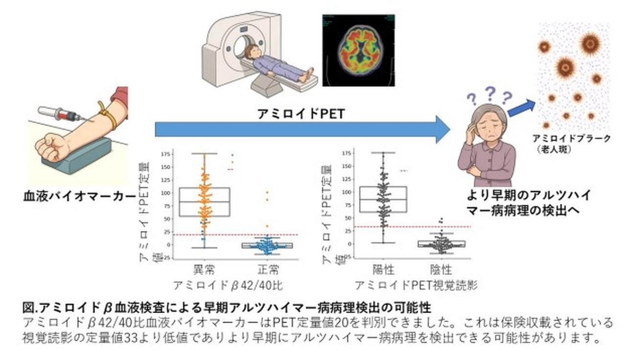 アルツハイマー病、PET検査より高精度な血液バイオマーカーが判明－慶